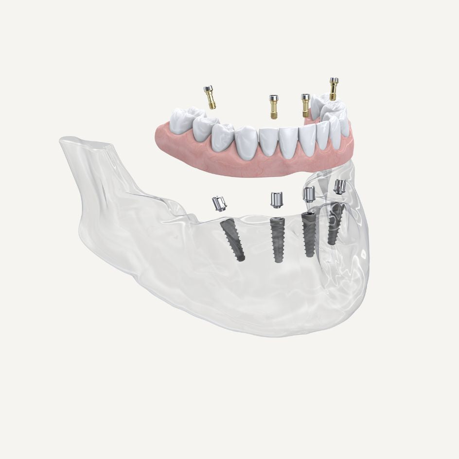 NeoBase® Abutment ASC abgewinkelter Schraubenzugangskanal